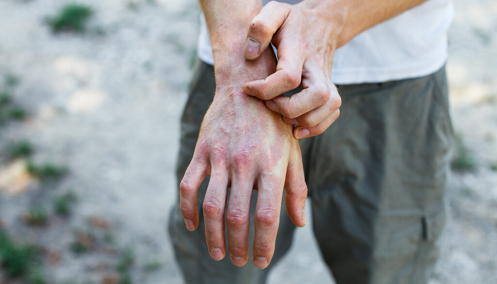 Closeup of a Man Scratching His Swollen Hand With Red Spots on It What Are the Early Warning Signs of Psoriatic Arthritis