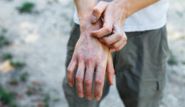 Closeup of a Man Scratching His Swollen Hand With Red Spots on It What Are the Early Warning Signs of Psoriatic Arthritis