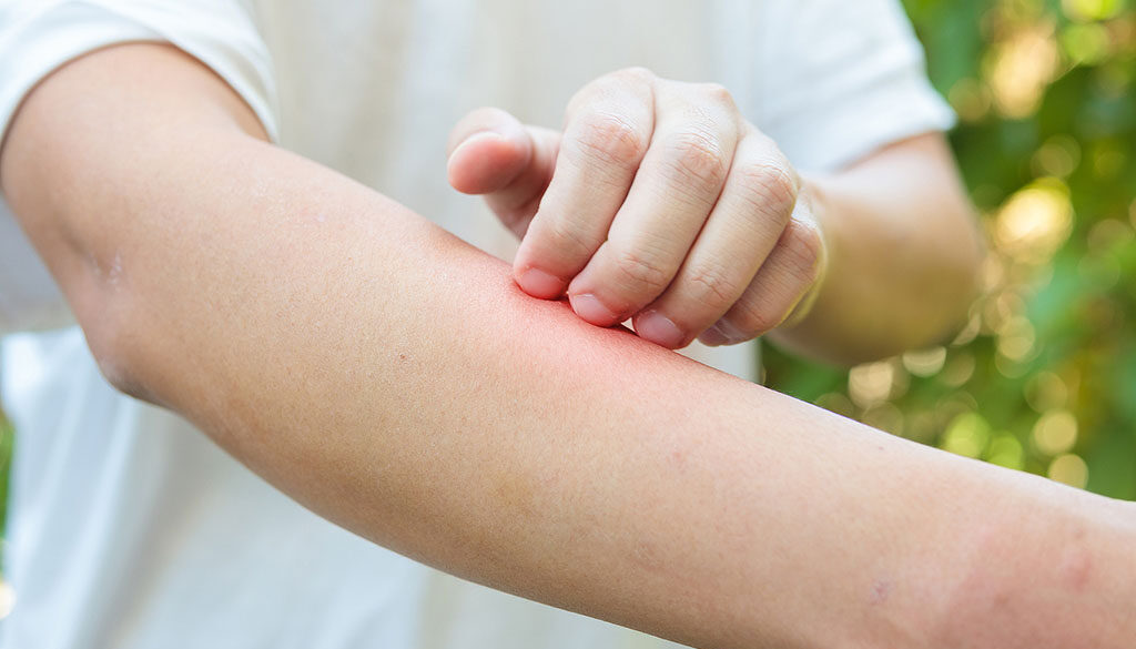 Closeup Of A Man Outdoors Scratching A Red Spot On His Arm From An Insect Sting Allergy
