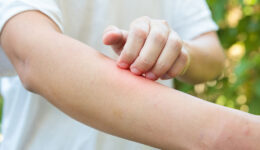Closeup Of A Man Outdoors Scratching A Red Spot On His Arm From An Insect Sting Allergy
