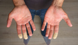 Closeup Of A Man Holding His Hands Out With Discolored Fingertips Caused By Types Of Scleroderma